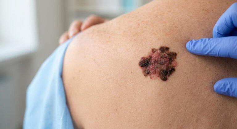 câncer de pele tipo melanoma